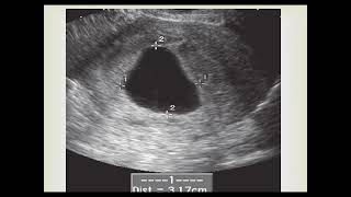 Ultrasound diagnosis of non viable early pregnancy [upl. by Yeh]