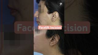 Facelift Incisions  Facelift Surgery Before After  Facelift Surgery in Hindi  SB Aesthetics [upl. by Diraf448]