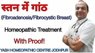 Breast Lump treatment । स्तन मे गाँठ का ईलाज ।fibroadenoma breast homeopathic treatment [upl. by Werdna]