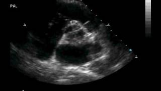 Transthoracic ECHO Parasternal Short Axis at the Aortic Valve [upl. by Asiral]