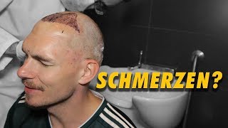 1 Tag nach der Haartransplantation Mit welchen Schmerzen muss man rechnen [upl. by Takakura]