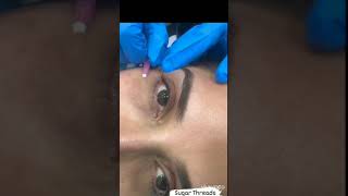 PDO Inch Thread for Under Eye Rejuvenation [upl. by Almallah581]