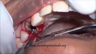 Periotome assisted upper premolar rootstump extraction [upl. by Aihseit]