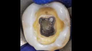 Protaper Next Case Report 2  Lower Right Second Molar with Pulp Stone [upl. by Eniamurt]