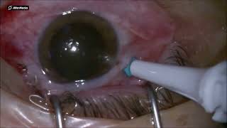 Anterior vitrectomy for high hyperopic eyes with very shallow AC and high IOP [upl. by Virnelli]