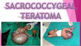 WHAT IS SACROCOCCYGEAL TERATOMA SCT ALL ABOUT ITS CAUSES SYMPTOMS PATHOLOGY DIAGNOSIS TREATMENT [upl. by Anwahsar719]