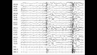 Syndromes epileptiques Pr Chentouf [upl. by Mia925]