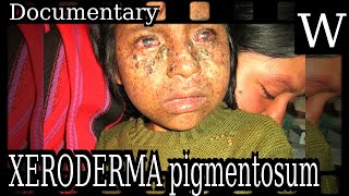 XERODERMA pigmentosum  WikiVidi Documentary [upl. by Aileahcim]