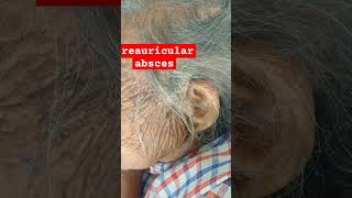 preauricular abscess [upl. by Grath]