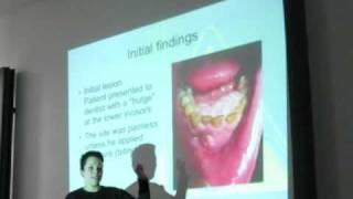 tobacco smoking and oral mouth cancer  a case study [upl. by Tiersten]