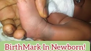 quot👶💕 BirthMarks in Newborns What You Need to Know for Your Babys Health 🤱‍♀️👶quot [upl. by Atimad]