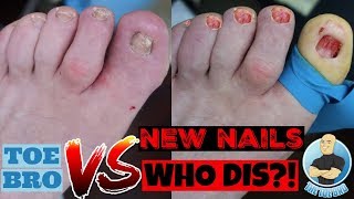 CAUSE OF AND CURE FOR THICK TOENAILS  FULL EXPLANATION amp TREATMENT [upl. by Nneb]