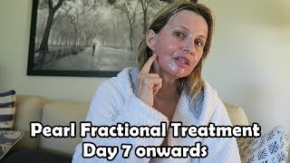 Pearl Fractional Treatment  Part 3  Day 7 onwards [upl. by Juanne]