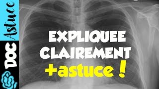 🔴6 APPRENDRE LE SYNDROME ALVEOLAIRE EN 5MIN  partie 2  DR ASTUCE [upl. by Nylatsyrk]