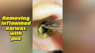 Removing inflamed earwax with pus [upl. by Ecylahs]