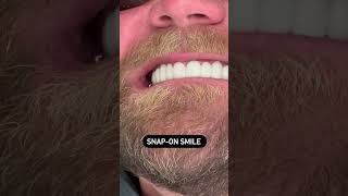 Dislike your smile  Veneers too pricey Check this amazing solution out  💕 [upl. by Akineg751]