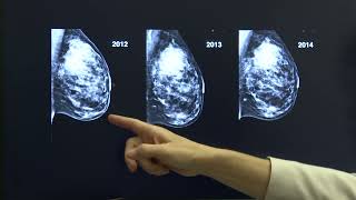 Higher breast cancer risk among Black women shows need for earlier screening Study [upl. by Vicki]