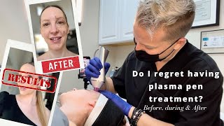 Plasma Pen Fibroblast Skin Tightening Everything You Need to Know  Treatment Review Before amp After [upl. by Gilchrist705]