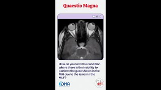 INTERNUCLEAR OPHTHALMOPLEGIA  OSPE amp OSCE  MBBS  NEXT   PLAB  USMLE  DMA [upl. by Reggie6]