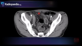 Comb sign of Crohns disease  radiology video tutorial CT [upl. by Gristede]