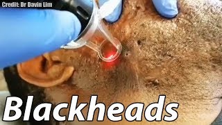 Worst Cystic Acne Biggest Blackheads and GIANT Cyst Removal [upl. by Eoin]