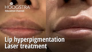 Lip hyperpigmentation  Laser treatment  24171 [upl. by Sokim922]