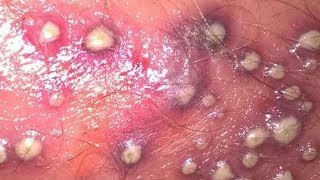 Worst Pimples I Have EVER Seen Pimple Popping amp Zit Removal [upl. by Noyek789]