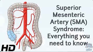 From Diagnosis to Recovery A Journey through Superior Mesenteric Artery Syndrome [upl. by Nats318]