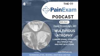 Multifidus Atrophy Multifidus Stimulation Peripheral Nerve Stimulation amp Leukocyte Rich PRP [upl. by Schiff]