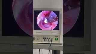 TTube Part3 hearingloss eardischarge tinnitus amazing [upl. by Rogers]