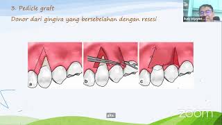 WEBINAR Regenerative Periodontal Treatment As Management Of Periodontitis [upl. by Eirolam710]