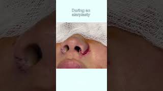 ALARPLASTY RESULTS  DR TANVEER JANJUA NEW JERSEY [upl. by Sweyn40]