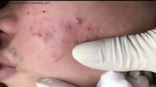 Acne treatment at home  squeeze pimple horror003 [upl. by Adai]