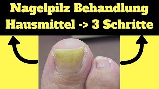 Nagelpilz Behandlung Hausmittel ✔ 3 Schritte um ekligen Nagelpilz loszuwerden [upl. by Semreh]