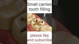 Small carries tooth filling asmr 3d localdentistry cavityfilling youtubeshorts ytshortsindia [upl. by Tierney296]