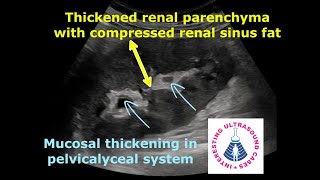 PYELONEPHRITIS ON ULTRASOUND  4 Different Cases  Emphysematous pyelonephritis [upl. by Naitsabas]