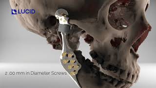 Total Joint Replacement TJR Animated Video  Custom TMJ Prosthesis [upl. by Filipe]