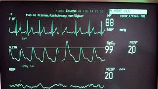 Ventricular Extrasystoles [upl. by Ttevi704]