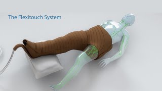 Treating Lymphedema  The Flexitouch System Lymphedema Pump [upl. by Alaj]