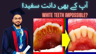 Top No 1 home remedy for dental plaque how to remove plaque tartar from teeth urdu  Hindi [upl. by Murage]