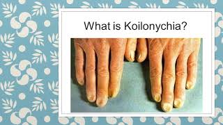 WHAT TO KNOW ABOUT KOILONYCHIA  NAIL DEFORMITIES  CLINICAL MEDICINE  MBBS REVISION GUIDE [upl. by Ori]