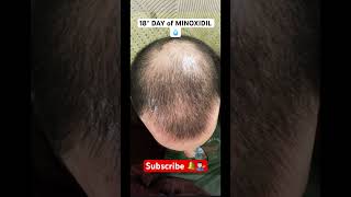 MINOXIDIL 5  18° DAY HAIRLOSS TREATMENT  CALVIZIE minoxidil hairloss calvizie baldness [upl. by Ridinger]