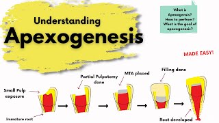 Apexogenesis  What is it  Endodontics [upl. by Eatnoled]