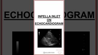 IMPELLA CP INLET ON ECHOCARDIOGRAM impella [upl. by Icat607]