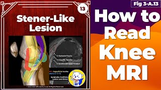 Fig 3A13 Stenerlike lesion of MCL avulsed distal MCL retracted medial to the pes tendons [upl. by Ynnav122]