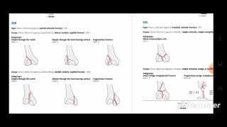 Fracture classification Part 2 by DrAnkita Gautam Assistant professor physiotherapy Rpiit [upl. by Gav]