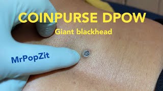 Coinpurse DPOW Giant blackhead removed Extended down to fat tissue below Punch excisionMrPopZit [upl. by Aiouqahs263]