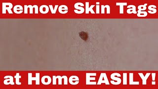 How to Remove Skin Tags  DIY Solutions That Really Work for Removing Skin Tags [upl. by Christina57]