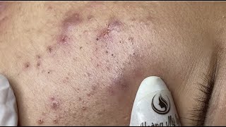 Remove blackheads for puberty boy HoangMySpa48 [upl. by Atirabrab332]