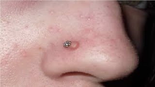 how to get rid of keloids on nose [upl. by Gilpin]